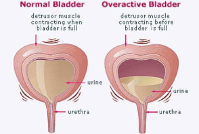 Εικ.2: Επιτακτική Ακράτεια Image