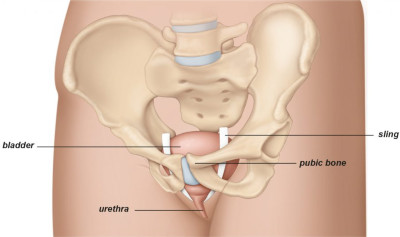 Εικ.3: Οπισθοηβική Ταινία Ακράτειας Image