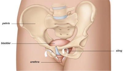 Εικ. 4: Διαθυροειδική Ταινία Ακράτειας Image