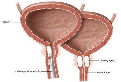 Εικ. 5: Έγχυση διογκωτικού παράγοντα Image