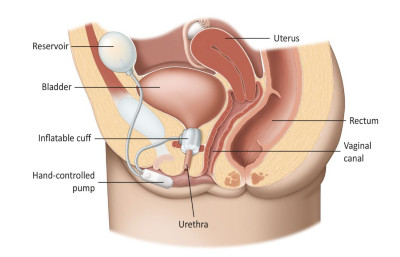 Εικ. 6: Τεχνητός Σφιγκτήρας Ακράτειας Image