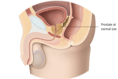 Εικ. 1: Προστάτης σε φυσιολογικό μέγεθος Image