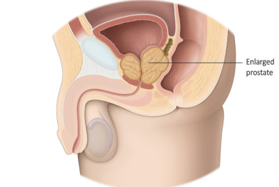 Εικ. 2: Καλοήθης Υπερπλασία τουΠροστάτη Image