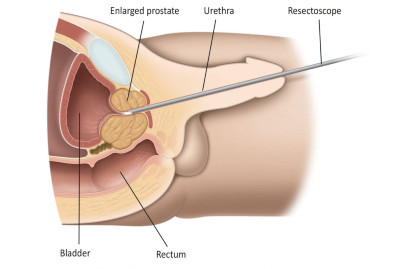 Εικ.3: Είσοδος του ρεζεκτοσκοπίου μέσω της ουρήθρας Image