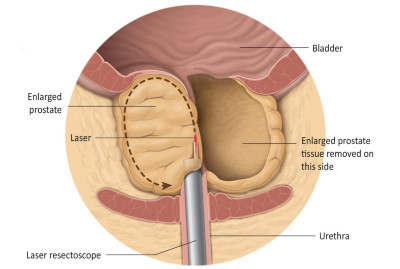 Εικ. 8: Το Λέιζερ κόβει και αφαιρεί τον προστατικό ιστό Image