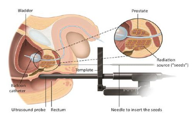Εικ. 4: Βραχυθεραπεία Image