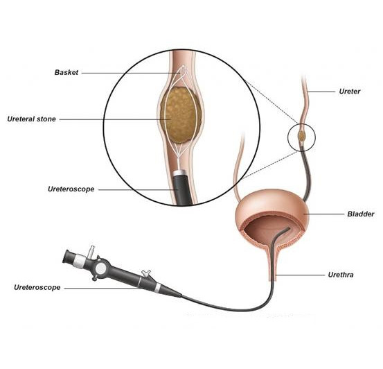 Εικ. 3: Αφαίρεση λίθου με την χρήση ενός basket Image