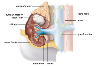 Εικ. 3: Όγκος σταδίου Ι Image