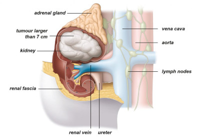 Εικ. 4: Όγκος σταδίου ΙΙ Image