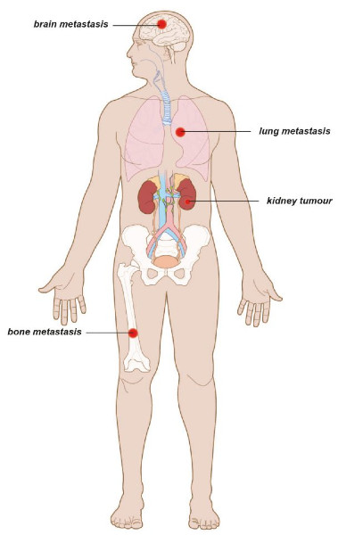 Εικ. 7: Ο μεταστατικός καρκίνος του νεφρού μπορεί να εξαπλωθεί στους πνεύμονες, τα οστά ή τον εγκέφαλο Image