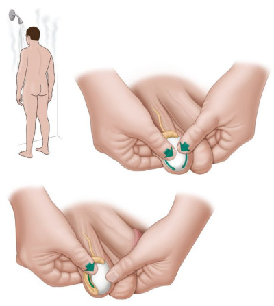 Εικ. 1: Προστάτης σε φυσιολογικό μέγεθος Image