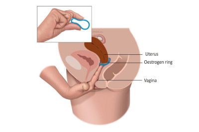 Εικ.3: Κολπικός Δακτύλιος Απελευθέρωσης Οιστρογόνων Image