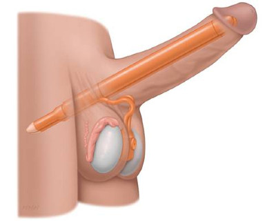 Εικ. 4: Φουσκωτό Εμφύτευμα 2 τεμαχίων Image