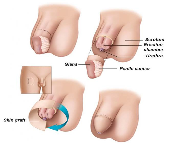 Μερική Πεεκτομή Image